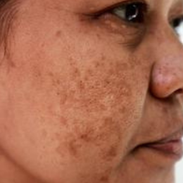 Pigmentation & Melasma Solution