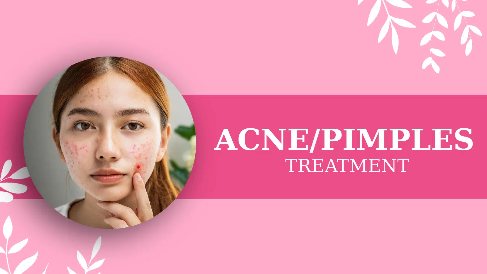 ACNEPIMPLES TREATMENT