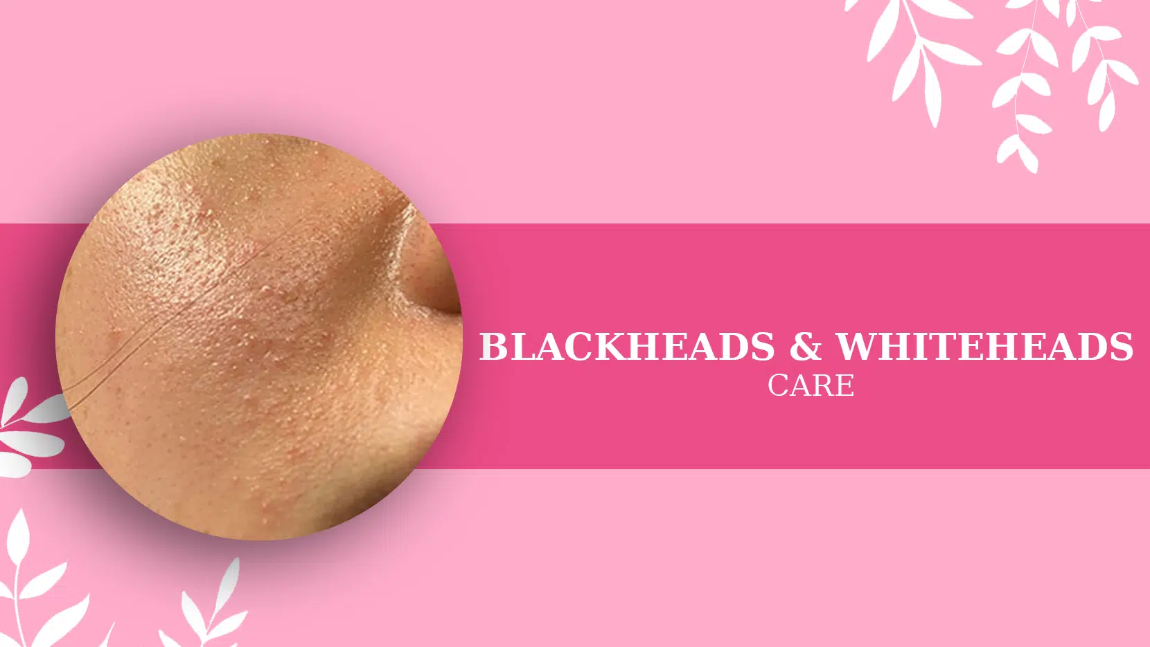 BLACKHEADS & WHITEHEADS