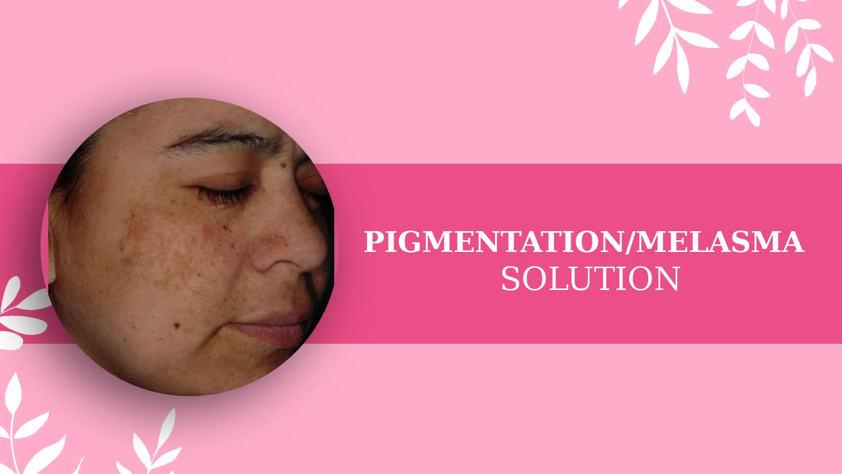 PIGMENTATION MELASMA