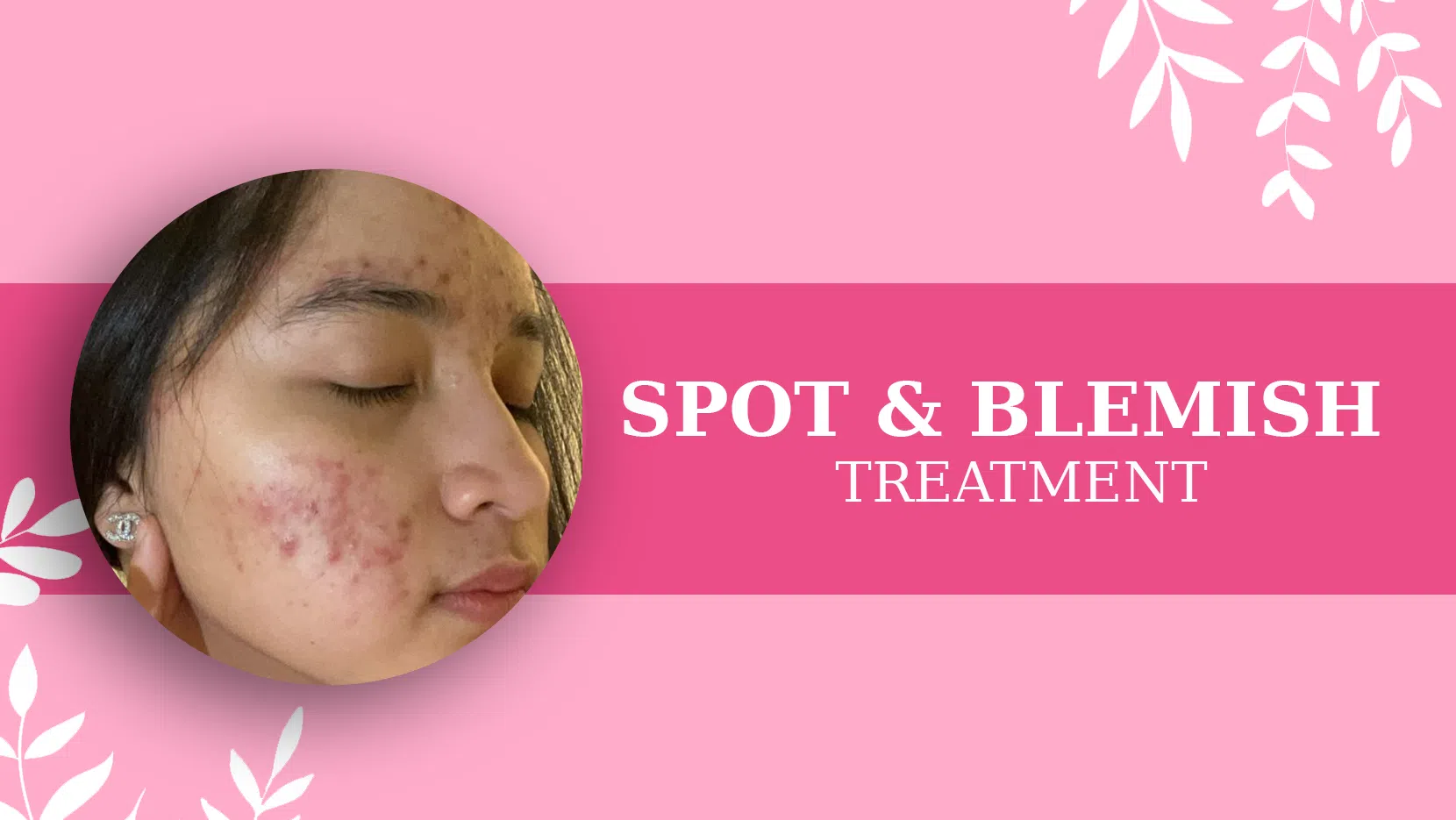 SPOT & BLEMISH